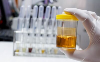 What Causes Blood in Urine? When to See a Doctor